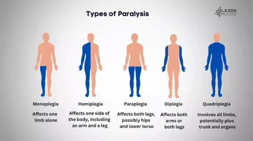 All forms of Paralysis - Disability