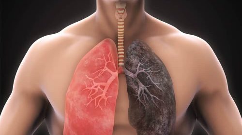 Chronic obstructive pulmonary disease