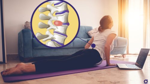 Disc Compression Bulge