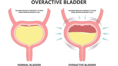 Overactive Bladder