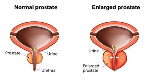 Prostate disorder
