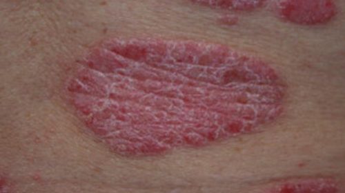 psoriasis-1